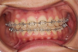 下の歯待ち、、、