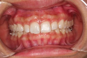 順調！！！インビザラインでホワイトニングも！