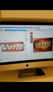インビザライン④
