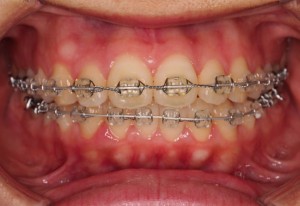 久しぶりの歯医者???