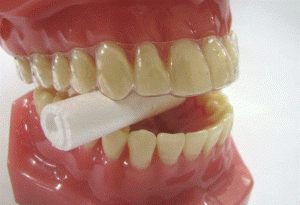 マウスピース型矯正装置（インビザライン）の「補助装置」とは何ですか？