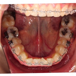 下の歯ワイヤーチェンジの巻
