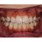 初めての交換とアタッチメント