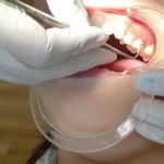 インビザラインとエラスティック