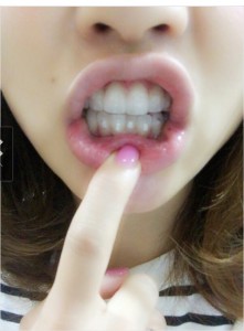 インビザライン⑥