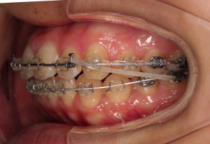 エラスティックゴム装着！！！