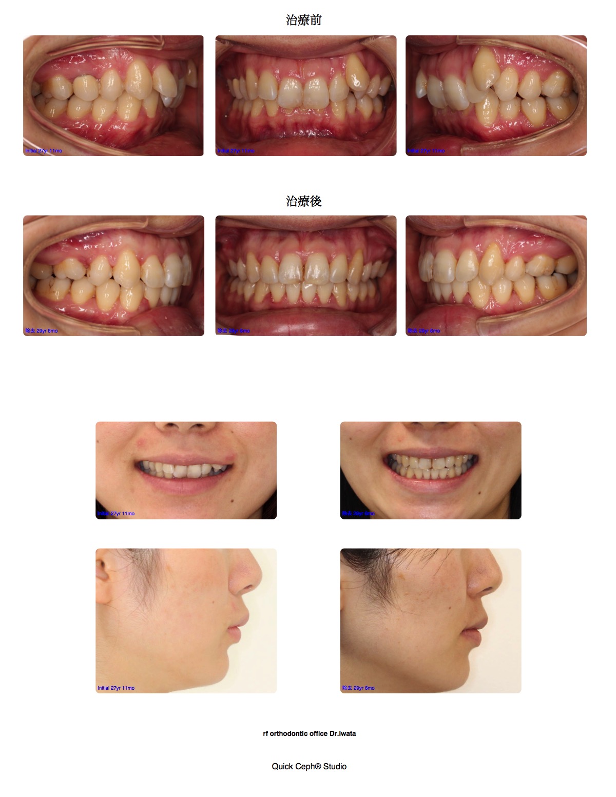過盖咬合症例　＜矯正用インプラントを併用した抜歯矯正治療＞