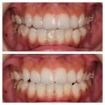 インビザライン装着時の見た目の比較