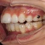 追加アライナーでリカバリー。そして産休へ！