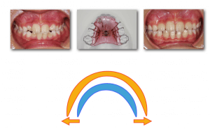 床矯正と普通の矯正治療は何が違うのですか?