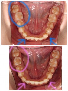 インビザライン⑦