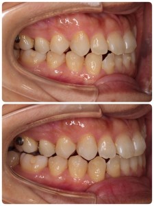 インビザライン⑦