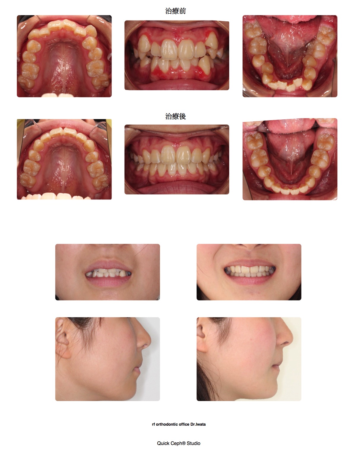 叢生症例　＜上下顎非対称抜歯矯正治療＞