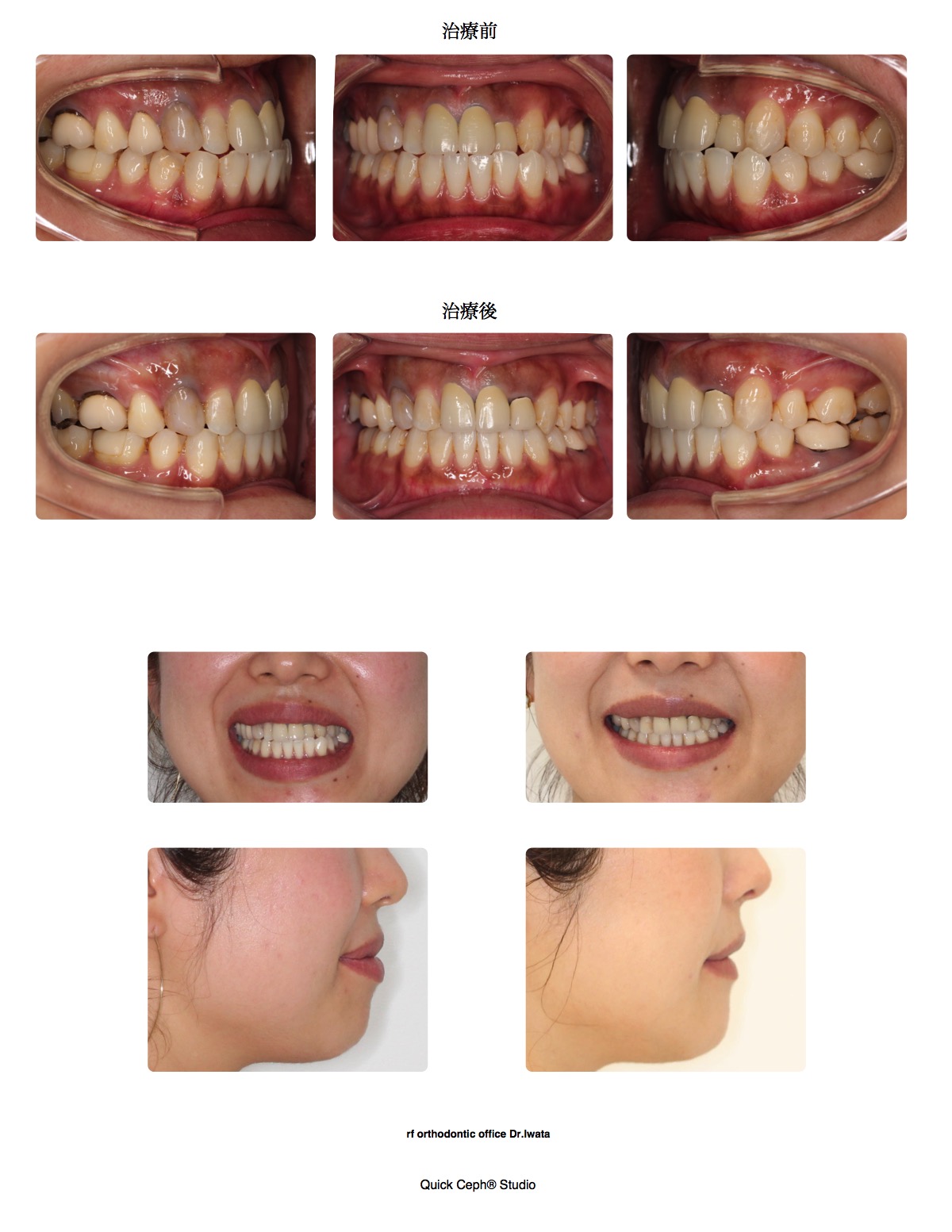 上下顎前突症例 <骨格性非対称を伴う歯列に対する上下顎第一小臼歯抜歯矯正治療>