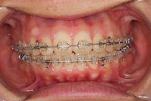 リテーナー作成