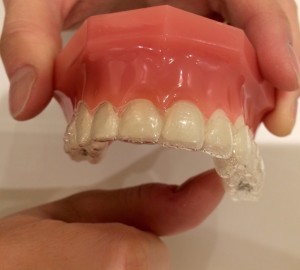 マウスピースの取り外しは大変ですか？