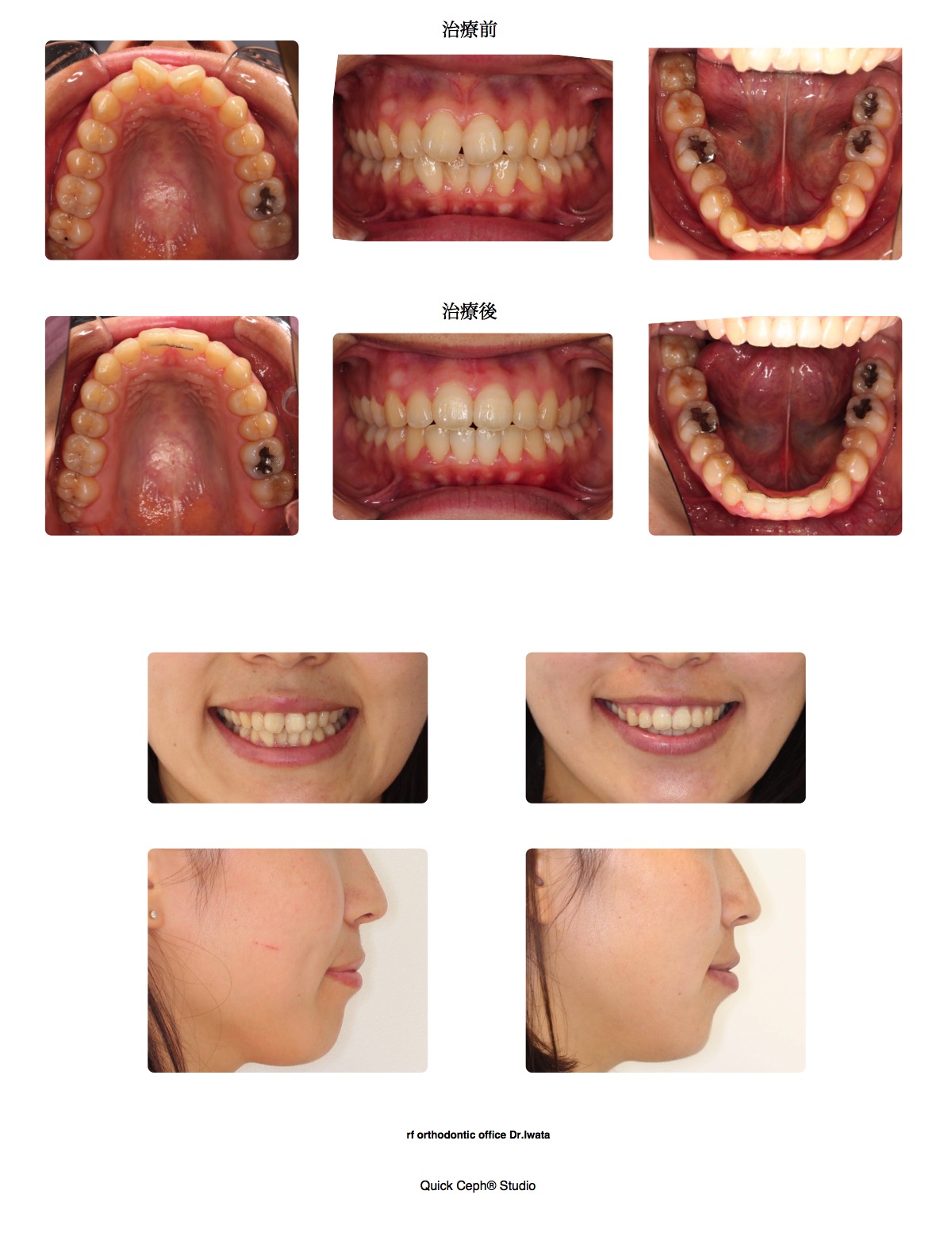 叢生症例　＜上顎前歯翼状捻転を伴う叢生に対する非抜歯矯正治療＞