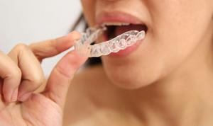 インビザライン