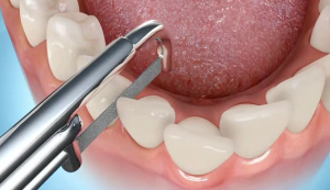 マウスピース型矯正装置（インビザライン）でよく聞く「IPR」ってなんですか？