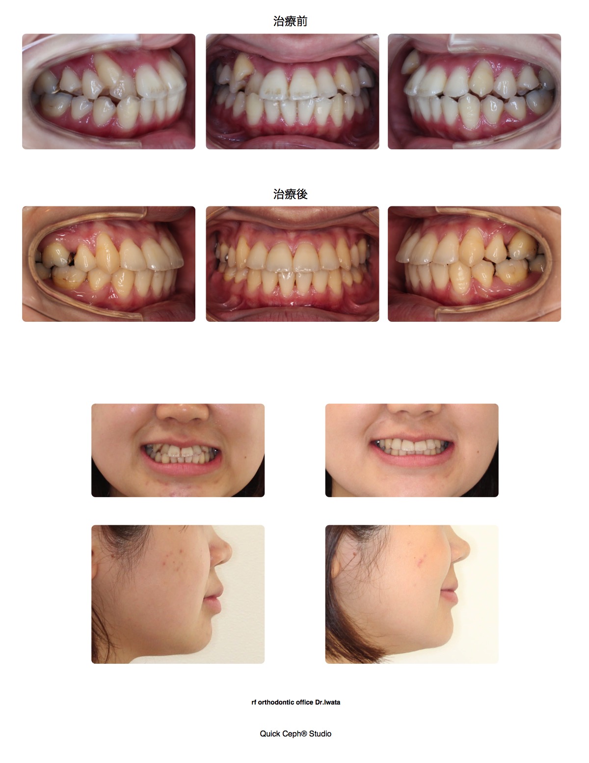 叢生症例　＜八重歯を伴う叢生に対する抜歯矯正治療＞