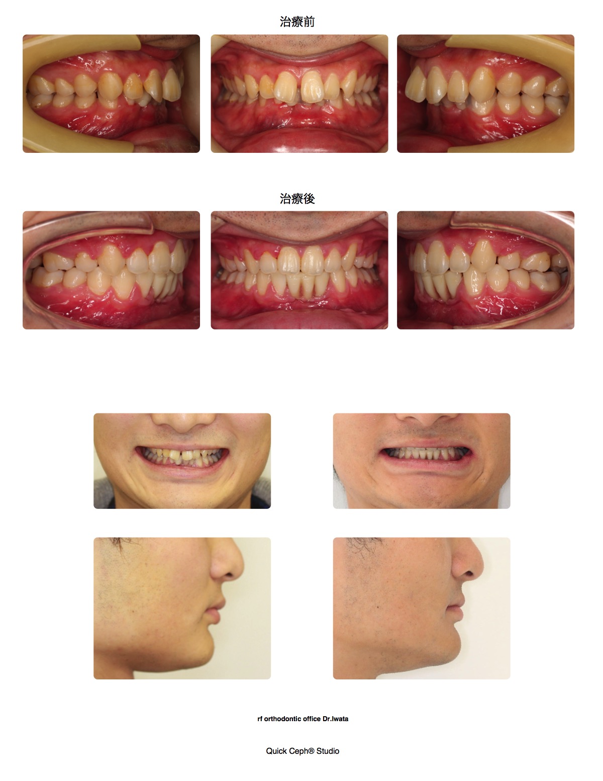 過盖咬合症例 <下顎前歯欠損を併う過蓋咬合に対する抜歯矯正治療>