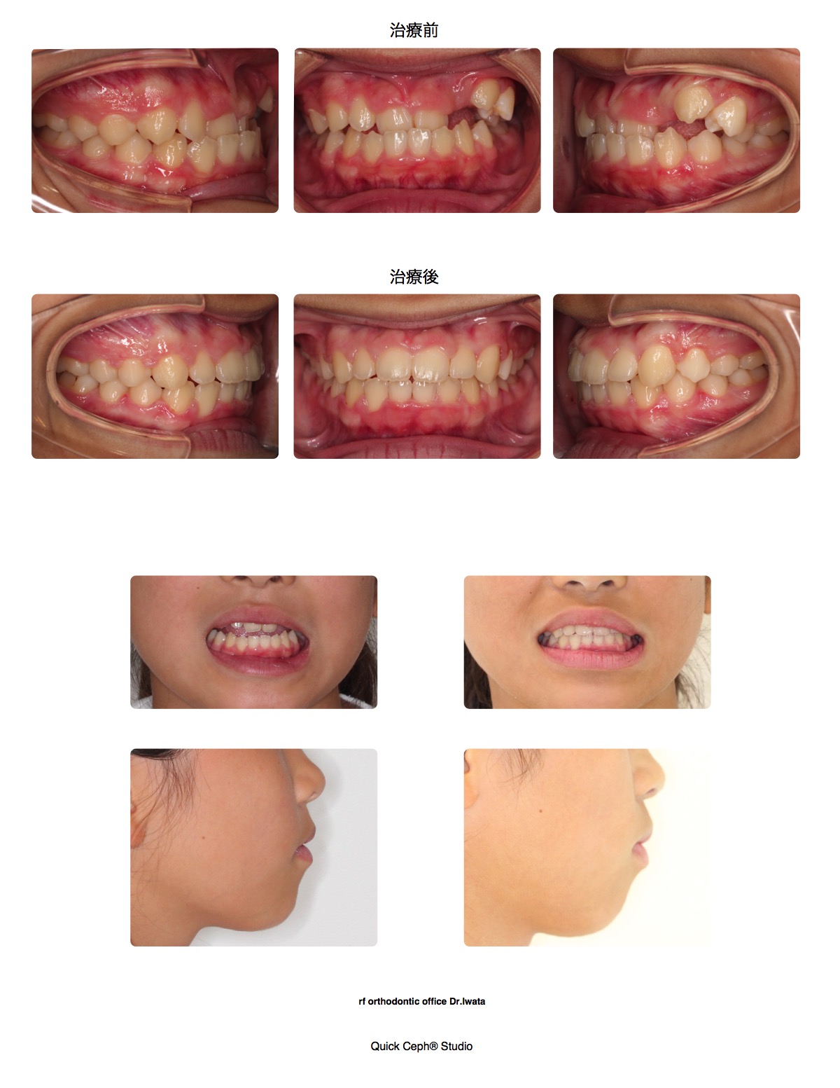 下顎前突症例　＜埋伏歯を伴う反対咬合に対する非抜歯矯正治療＞
