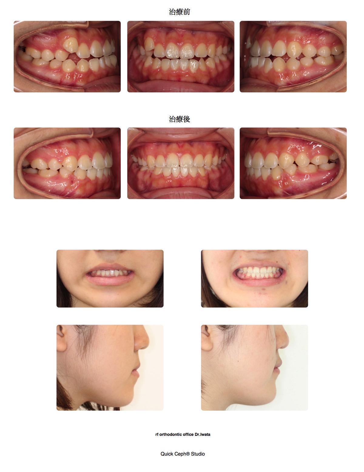 下顎前突症例　＜顎間ゴムを併用した上下顎非対称抜歯矯正治療＞