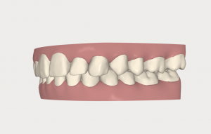 すごい雨…でもインビザラインの型取りに来た！
