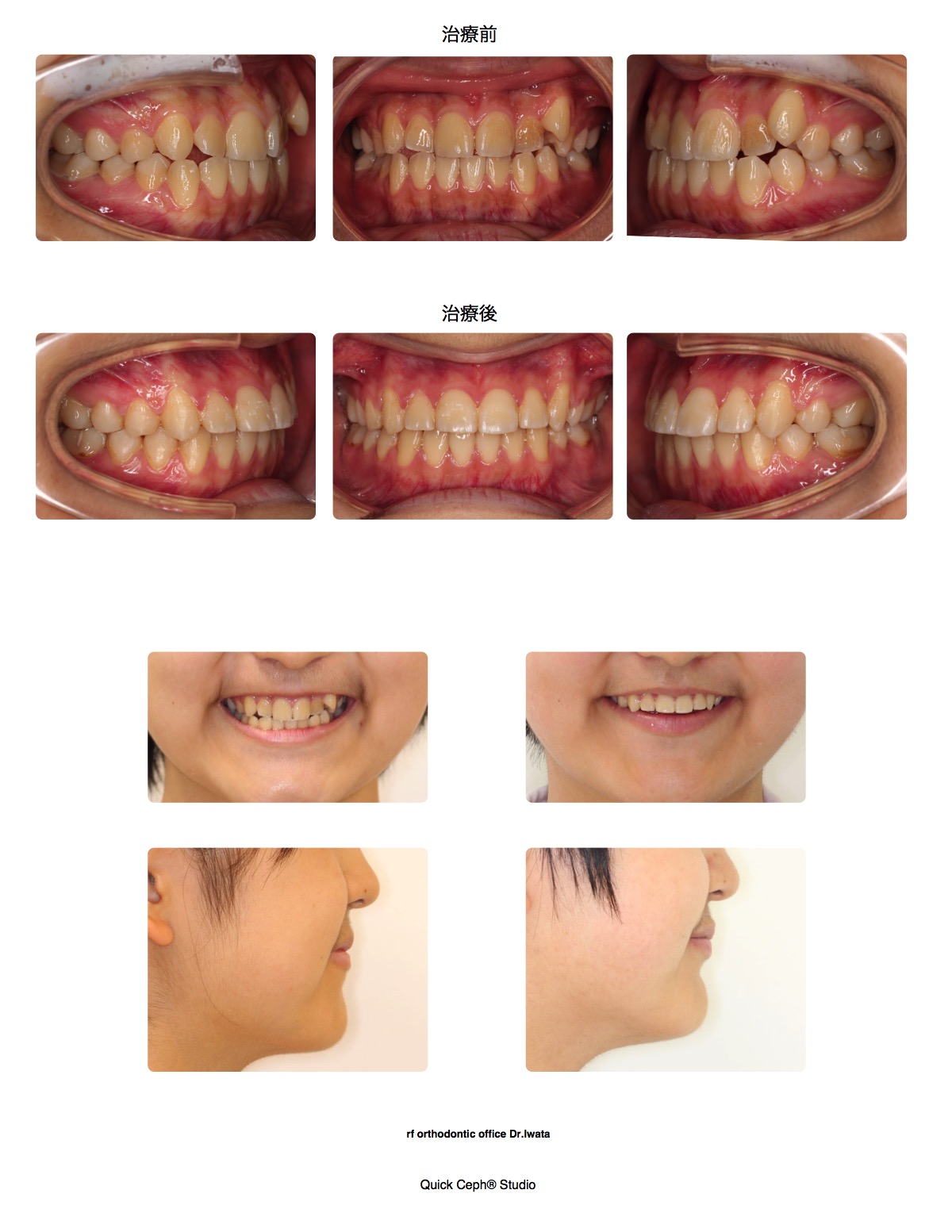 叢生症例　＜八重歯と上下顎正中のズレを伴う叢生に対する片側抜歯矯正治療＞