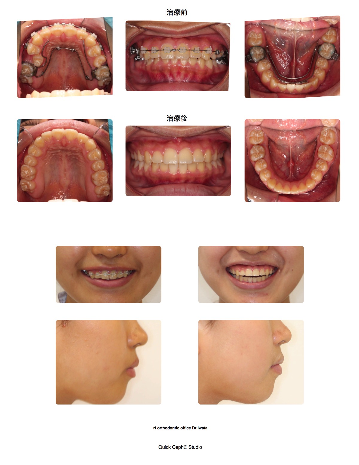 鋏状咬合症例　＜小臼歯捻転を伴うシザースバイトに対する非抜歯矯正治療＞