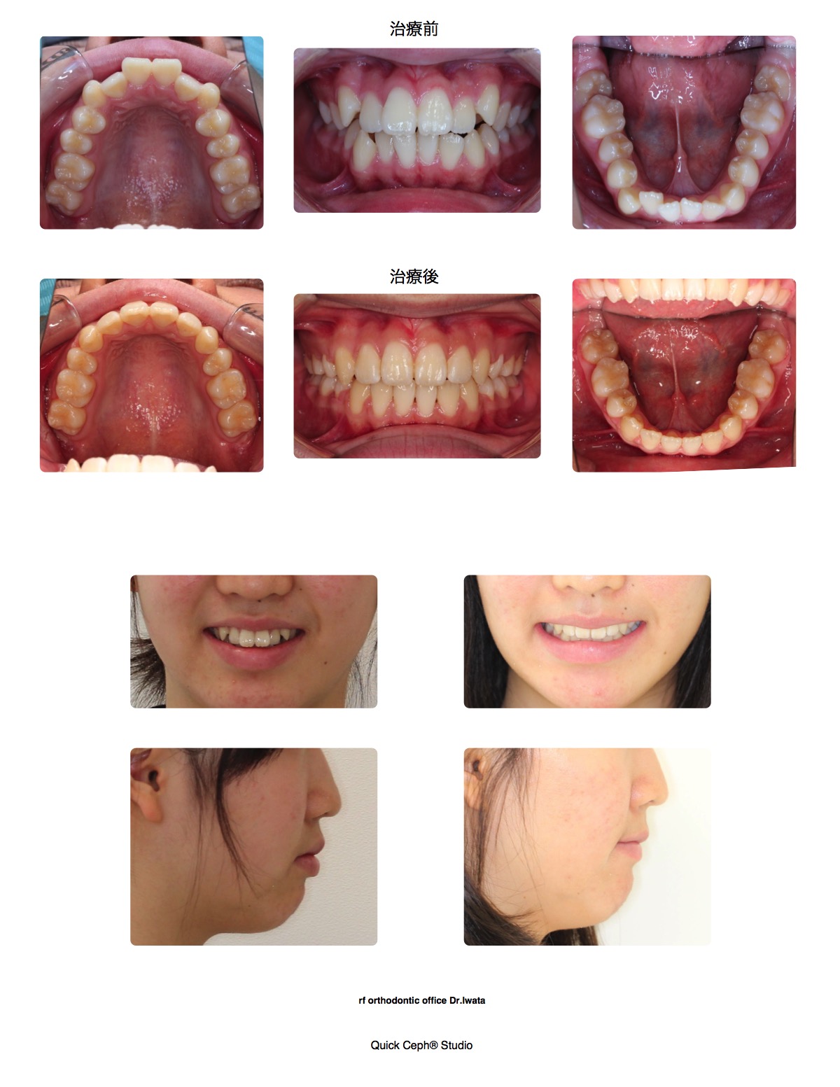 叢生症例　＜八重歯と下顎大臼歯埋伏を伴う叢生に対する抜歯矯正治療＞