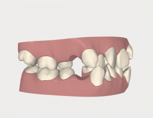 マウスピース型矯正装置（インビザライン）では抜歯矯正は適応できないのでしょうか？