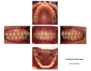 矯正治療終了〜〜〜！！！