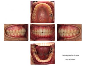 矯正治療終了〜〜〜！！！