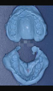 インビザライン⑨