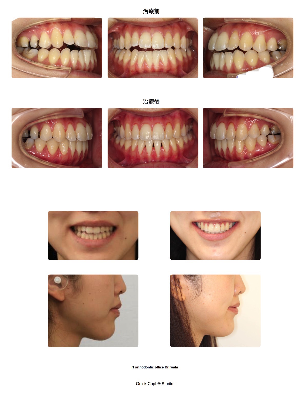 開咬症例　＜顎間ゴムを併用した非抜歯矯正治療＞