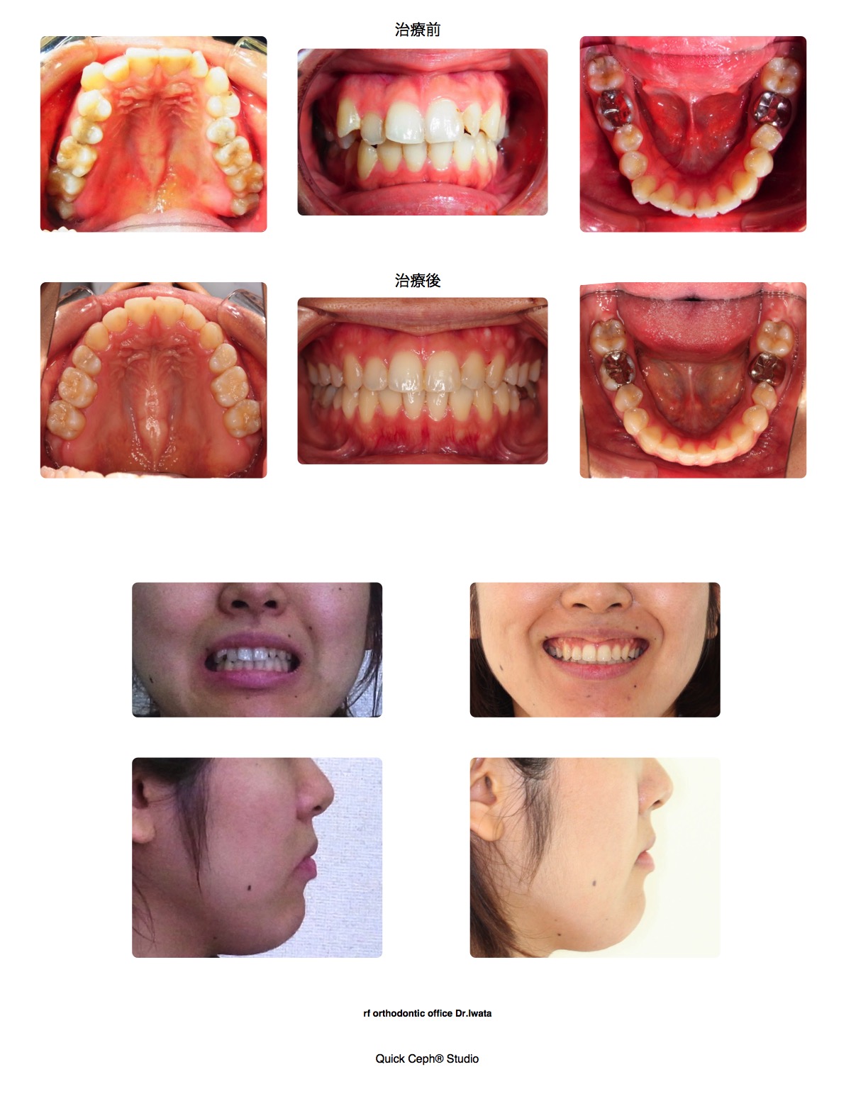叢生症例　＜八重歯と小臼歯捻転を伴う叢生に対する片顎抜歯矯正治療＞