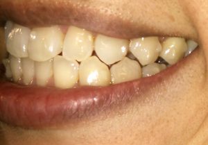 インビザライン⑩