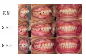 出っ歯は矯正治療をした方がいいですか？