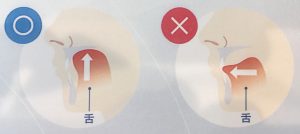 矯正治療日記 vol.28 「プレオルソってどんな歯並びを治せるの？」