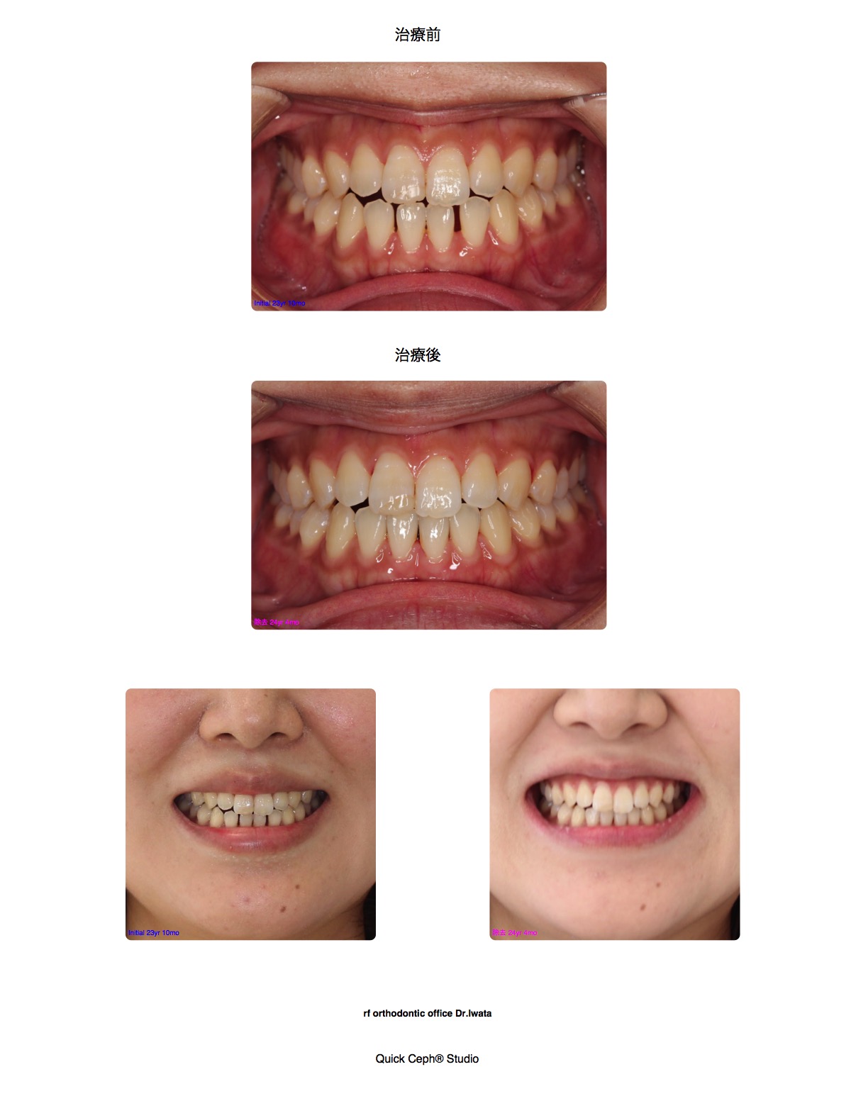 空隙歯列症例 <下顎前歯のみの部分矯正治療>