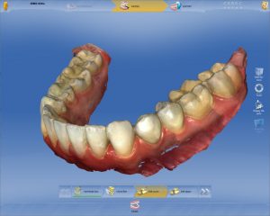 インビザラインのための光学3Dスキャナー「CEREC」を導入しました