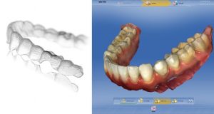 インビザラインのための光学3Dスキャナー「CEREC」を導入しました