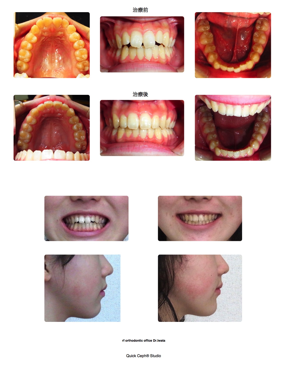 開咬症例　＜遠方のため定期通院が困難な患者に対する非抜歯矯正治療＞