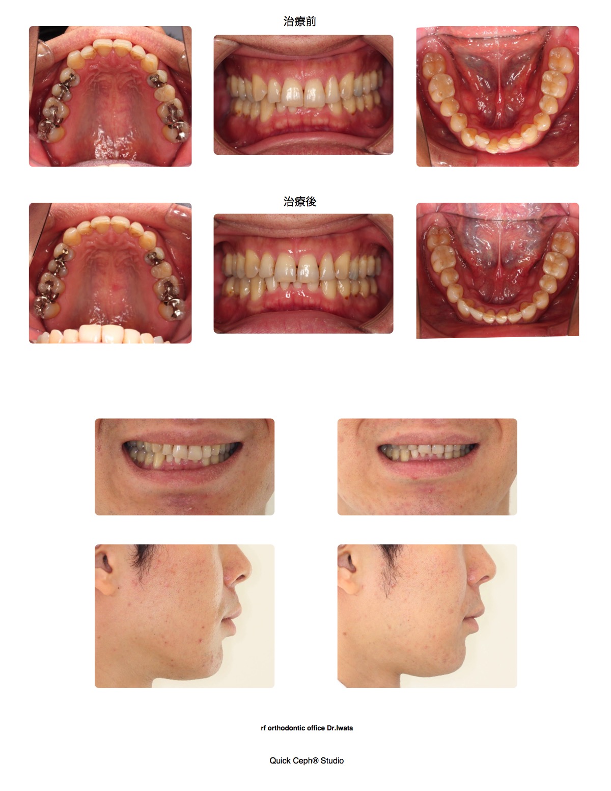 叢生症例　＜奥歯の骨が少ないため他院で治療困難と診断された部分矯正治療＞