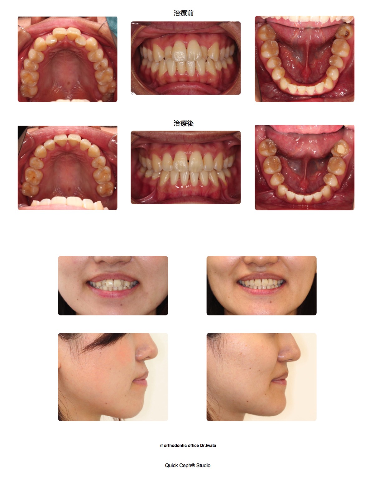 上下顎前突症例 <口元を後退させた上下顎第一小臼歯抜歯矯正治療>