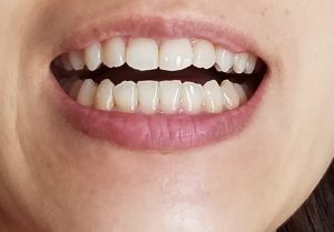 インビザライン⑫