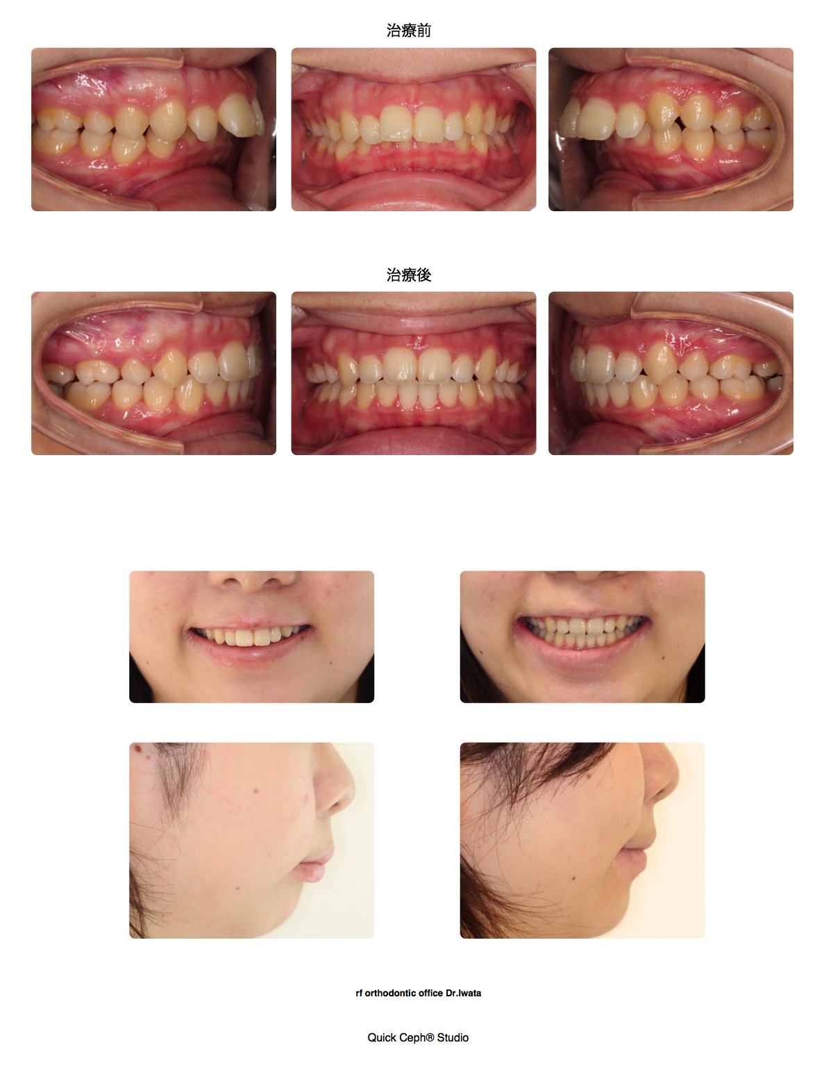 上顎前突症例 　＜矯正用インプラントアンカーを併用した上顎第一小臼歯抜歯矯正治療＞