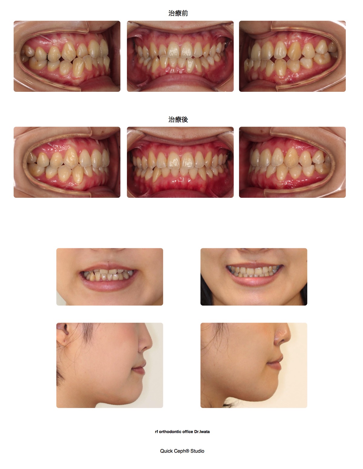 下顎前突症例　＜インビザラインによる遠心移動にて改善を行った非抜歯矯正治療＞