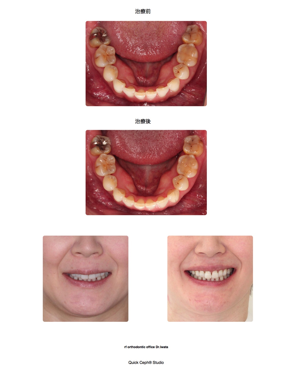 叢生症例　＜矯正治療後の後戻りに対する下顎前歯のみの部分矯正治療＞